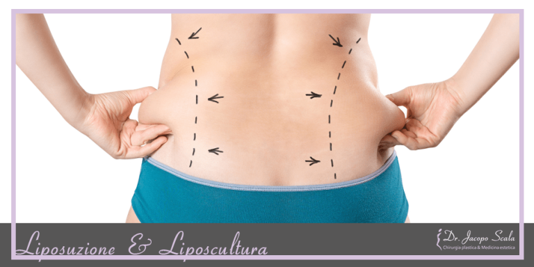 liposuzione liposcultura dimagrimento firenze