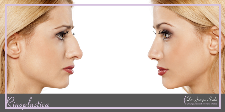 Rinoplastica firenze dottor scala
